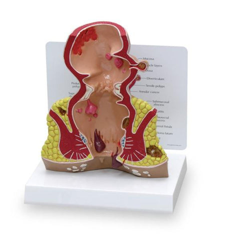 Nasco Healthcare, Inc Rectum Model Anatomical 1-1/2 Life-Size Each - SB35433