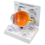 CORNEAL EYE MODEL